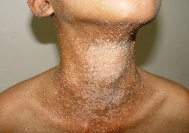 Pessoa com escabiose